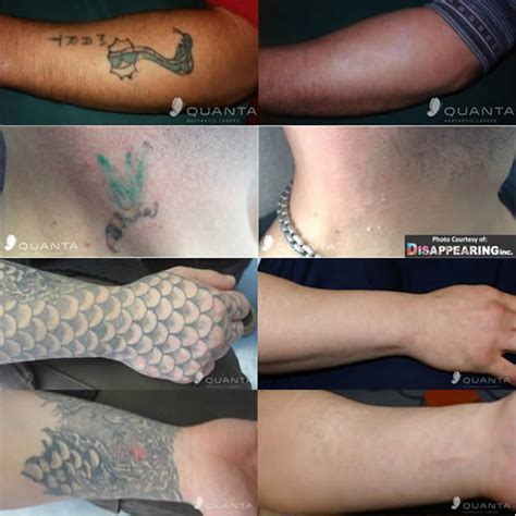 Laser Tattoo Removal in Liverpool | Epilight New Skin Clinic