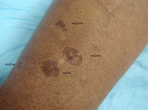 Recognizing Skin Popping Scars and the Benefits of Early Intervention - Dermatology Advisor