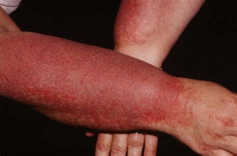 Dermatomyositis - Causes, Rash, Symptoms, Diagnosis & Treatment