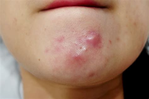 How to Prevent Cystic Acne [AND] Get Rid of Cystic Acne! NATURALLY...