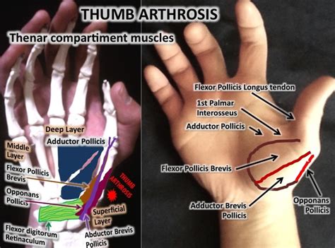 Thumb arthrosis by adhesions: osteopathic treatment