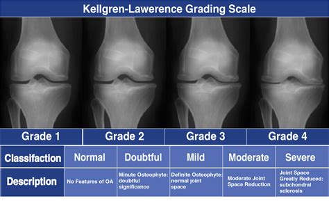 Guide to Severe Knee Arthritis (Osteoarthritis) - Spring Loaded Technology