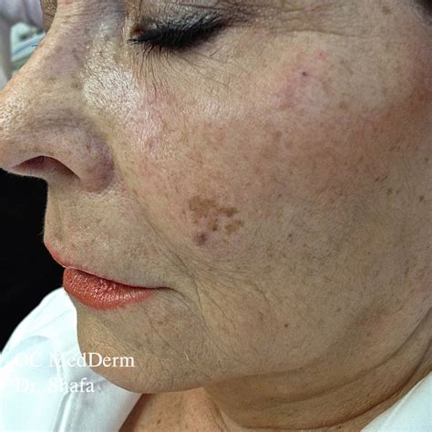 Skin Discoloration Treatment Orange City | Irvine Skin