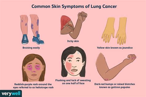 Lung Cancer Symptoms on the Skin to Watch For