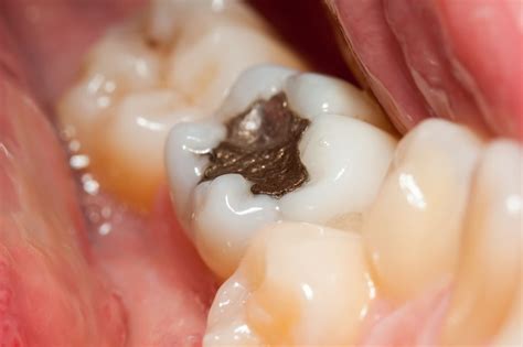 Is It Time to Replace Your Amalgam Fillings? - Integrative Dentistry of Chester County