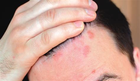 How To Deal With Scalp Sores? - Life Health Max