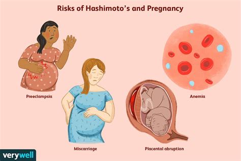 Hashimoto’s Disease and Pregnancy: Fertility and Gestation