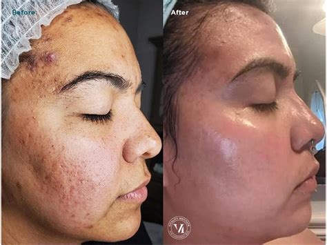 Acne Scars Treatment - Best of Atlanta Winner 2024 | ELLEMES Medical Spa