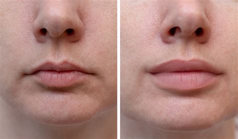 Droopy Lips Surgery | Lipstutorial.org