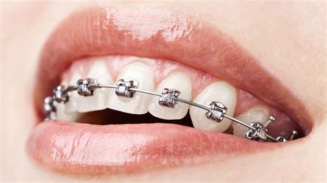 Sapphire transparent braces - Clinicile Dentare Dr. Leahu