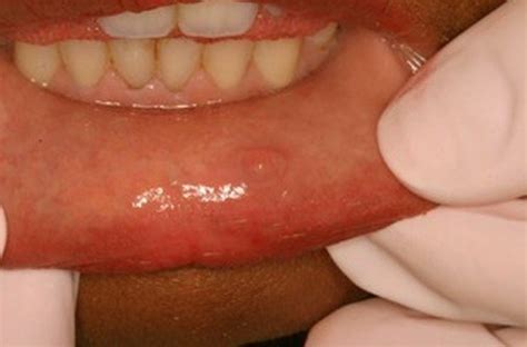 Mucous Cyst Inside Lip | Sitelip.org