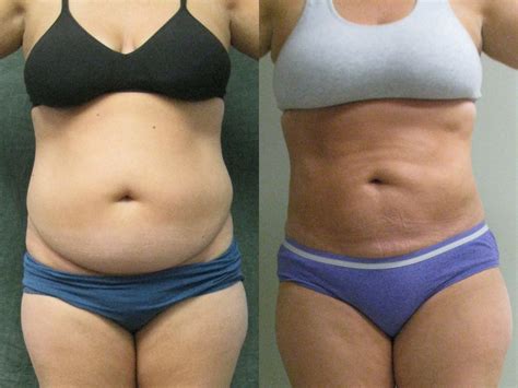 liposuction for menopause belly - Kory Yoo