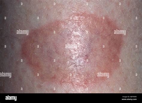 Necrobiosis Lipoidica Histology