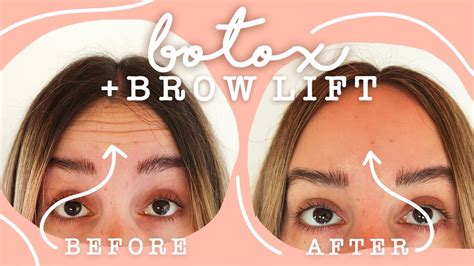 Botox Brow Lift Before And After Pics, Brow Lift Before And After ...