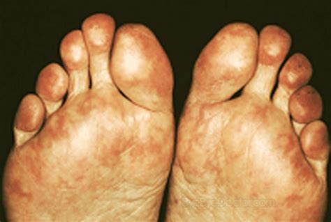 Livedo Reticularis (Mottling Skin) Causes, Pictures, Treatment