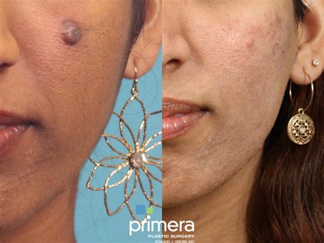 Cyst Removal Before and After Photo Gallery | Orlando, Florida | Primera Plastic Surgery