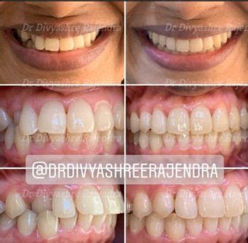 Before and After| Invisalign| Cross bite, protruded teeth correction in ...