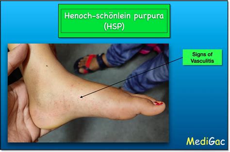 Henoch-Schonlein Purpura(HSP) – Clinical features || Pathophysiology ...