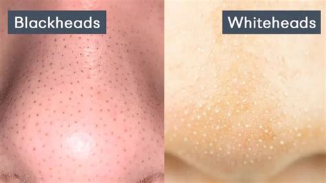 Understanding Blackheads and Whiteheads: Causes, Differences, and Simi ...