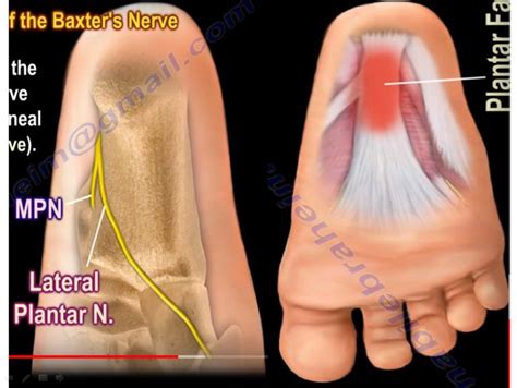 Heel pain and the Baxter’s Nerve — OrthopaedicPrinciples.com