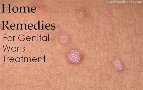 gential wart treatments - pictures, photos