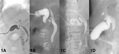 Frontiers | Management of Patients With Acute Cholecystitis After Percutaneous Cholecystostomy ...