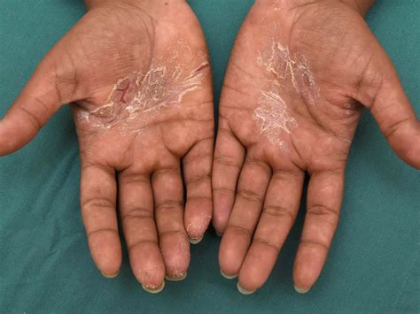 Hand Eczema | About and Treatments | Eczema.org