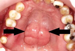 Know about Torus palatinus | The Dental Arcade – Blog