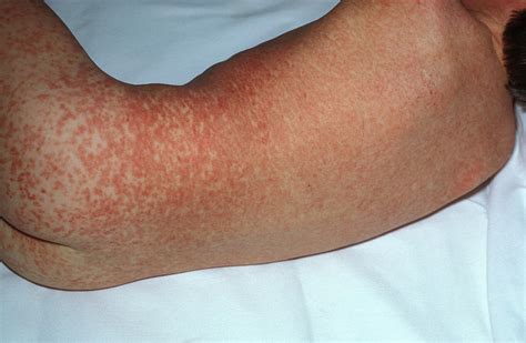 Measles Rash