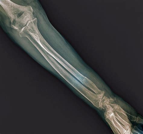 Fractured Ulna Arm Bone by Science Photo Library