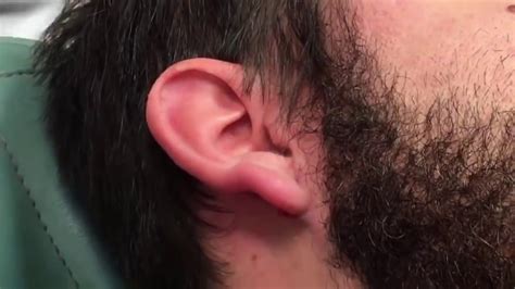 Cyst Bursting Saturday; Biggest Ear Cyst of 2018 - Just the Pop! - YouTube