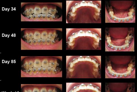 My Journey with the Damon Braces: Progress for the past 23 weeks in Pictures