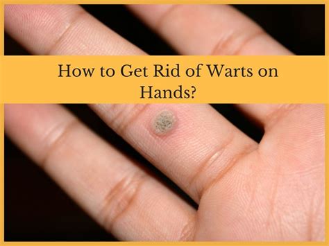 How to get rid of warts on hands and fingers - What causes warts on ...