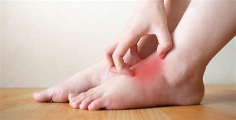 Foot Cellulitis – Royal Podiatry