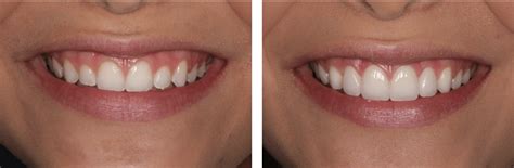 Gum Recontouring | San Diego & La Mesa | Hornbrook Center for Dentistry