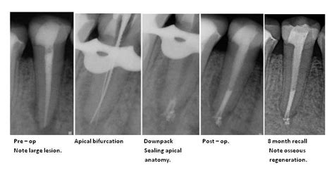 apical – Dana Point Endodontics | Daniel J. Boehne, DDS | Board Certified Endodontist