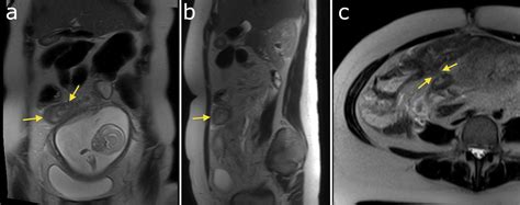 Crohn disease - MRI - Radiology at St. Vincent's University Hospital