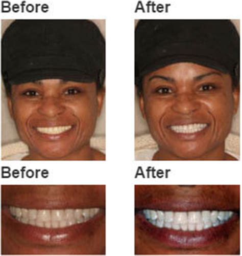 Whitening for Life - Teeth Whitening Experts in Brooklyn NY