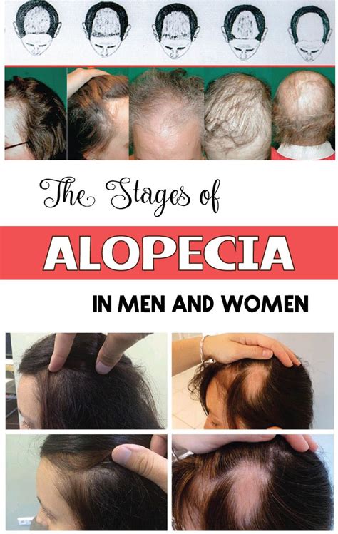 If there are different types of alopecia, the most common is androgenetic alopecia. Inherited ...