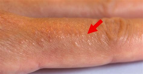 If You See These Painful Red Bumps, You May Have Dyshidrotic Eczema – Animals Life