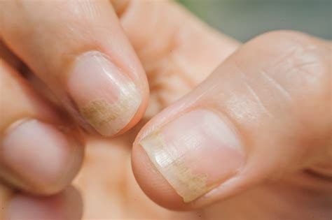 Finger Nail Fungus Causes at Rodolfo Summerville blog