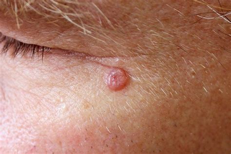 Basal Cell Carcinoma | Honolulu, HI | John D. Boyer, M.D., Inc.