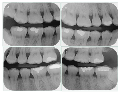 Técnica bite wing | Imágenes RX Dental