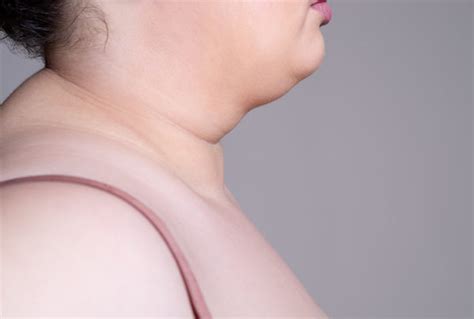 Neck Fat Causes: Reduce It with Surgery, Chewing Gum, etc.