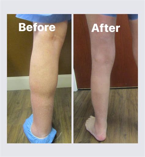 Lymphedema in Omaha, NE | Venus Vein Clinic