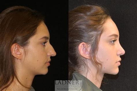 Rhinoplasty (Nose job) Before and After Photo Gallery | Denver, CO ...