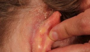 Crusty Behind Ears Causes, Symptoms, Dry Skin, Psoriasis, Skin ...