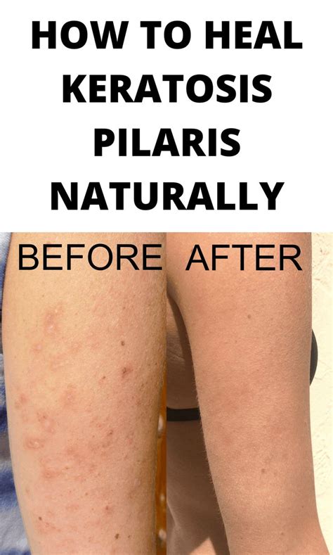 Keratosis Pilaris Before And After