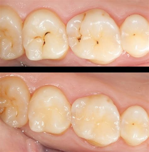 Dental Caries Diagnosis