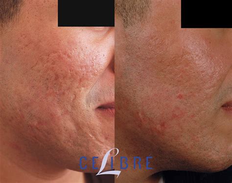 Acne Scar Removal Before and After Pictures of Actual Patients